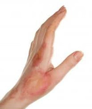 Le top 10 des accidents domestiques:  En 2e place, la brûlure