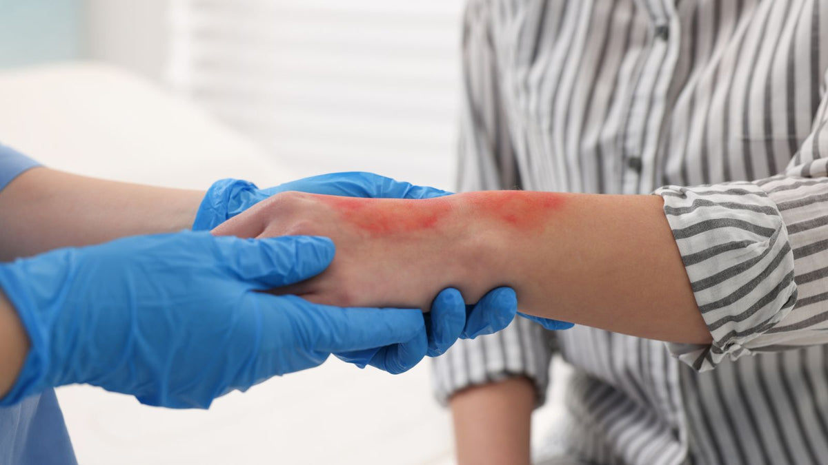Comment soigner une brûlure rapidement : gel anti-brûlure et pansement premiers soins SuperMedic