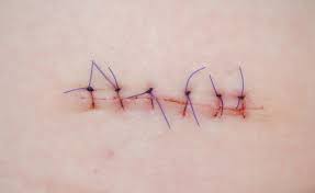 Ginette doit-elle avoir des points suture?