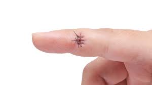 Les points de suture.  Quand et pourquoi ?